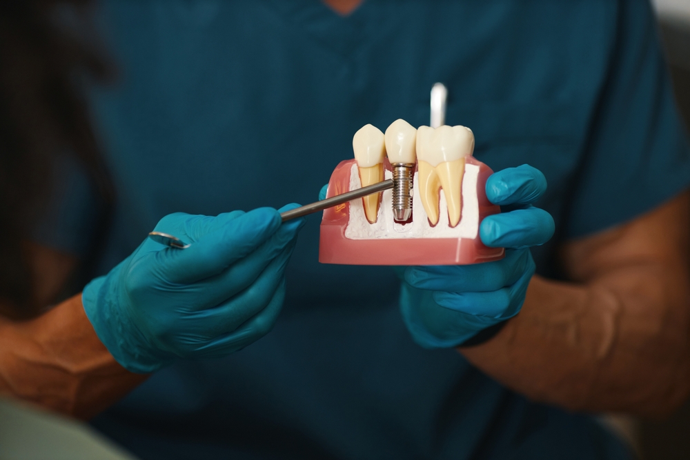 Dental implants in Sharjah at Kids & Family Dental Clinics LLC SP